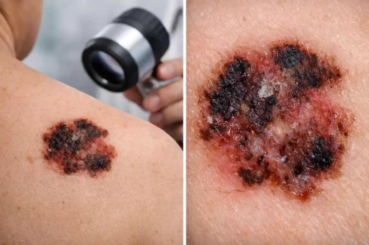 Опасные признаки рака кожи: что ИИ замечает первым